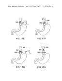 DEVICES AND METHODS FOR GASTROINTESTINAL BYPASS diagram and image