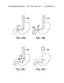 DEVICES AND METHODS FOR GASTROINTESTINAL BYPASS diagram and image