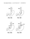 DEVICES AND METHODS FOR GASTROINTESTINAL BYPASS diagram and image