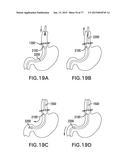 DEVICES AND METHODS FOR GASTROINTESTINAL BYPASS diagram and image