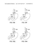 DEVICES AND METHODS FOR GASTROINTESTINAL BYPASS diagram and image