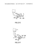 DEVICES AND METHODS FOR GASTROINTESTINAL BYPASS diagram and image