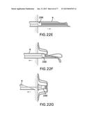 DEVICES AND METHODS FOR GASTROINTESTINAL BYPASS diagram and image