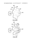 DEVICES AND METHODS FOR GASTROINTESTINAL BYPASS diagram and image