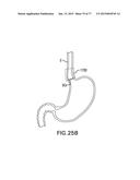 DEVICES AND METHODS FOR GASTROINTESTINAL BYPASS diagram and image