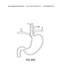 DEVICES AND METHODS FOR GASTROINTESTINAL BYPASS diagram and image