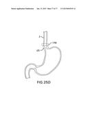 DEVICES AND METHODS FOR GASTROINTESTINAL BYPASS diagram and image