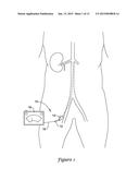 DEVICES AND METHODS FOR NERVE MODULATION diagram and image