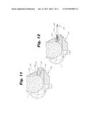 IMPLANT FIXATION MEMBER HOLDER diagram and image