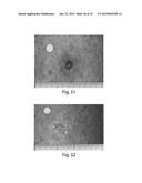 METHODS FOR TREATMENT OF ONCOLOGICAL DISORDERS USING AN EPIMETABOLIC     SHIFTER (COENZYME Q10) diagram and image