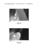 METHODS FOR TREATMENT OF ONCOLOGICAL DISORDERS USING AN EPIMETABOLIC     SHIFTER (COENZYME Q10) diagram and image