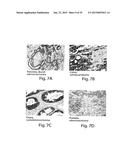 METHODS AND COMPOSITIONS FOR IDENTIFICATION, ASSESSMENT AND TREATMENT OF     CANCERS ASSOCIATED WITH HEDGEHOG SIGNALING diagram and image