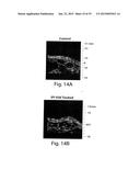 METHODS AND COMPOSITIONS FOR IDENTIFICATION, ASSESSMENT AND TREATMENT OF     CANCERS ASSOCIATED WITH HEDGEHOG SIGNALING diagram and image