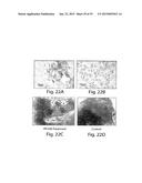 METHODS AND COMPOSITIONS FOR IDENTIFICATION, ASSESSMENT AND TREATMENT OF     CANCERS ASSOCIATED WITH HEDGEHOG SIGNALING diagram and image