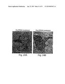 METHODS AND COMPOSITIONS FOR IDENTIFICATION, ASSESSMENT AND TREATMENT OF     CANCERS ASSOCIATED WITH HEDGEHOG SIGNALING diagram and image