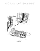 SPINAL CANAL ACCESS AND PROBE POSITIONING, DEVICES AND METHODS diagram and image