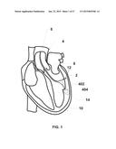 ENDOVENTRICULAR INJECTION CATHETER SYSTEM WITH INTEGRATED     ECHOCARDIOGRAPHIC CAPABILITIES diagram and image