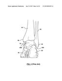 FOOT STABILIZER SOCKS AND STABILIZER PADS THEREFOR diagram and image