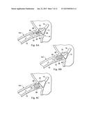 Stent Delivery Under Direct Visualization diagram and image