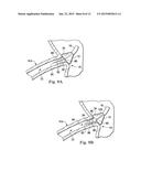 Stent Delivery Under Direct Visualization diagram and image