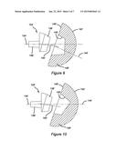 SHOULDER PROSTHESIS diagram and image