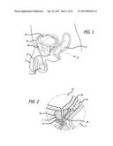 CONTINUOUS INDENTATION LATERAL LOBE APPARATUS AND METHOD diagram and image