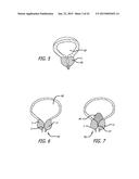 CONTINUOUS INDENTATION LATERAL LOBE APPARATUS AND METHOD diagram and image