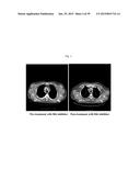 USE OF INHIBITORS OF BRUTON S TYROSINE KINASE (BTK) diagram and image