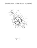 DIRECT VISION CRYOSURGICAL PROBE AND METHODS OF USE diagram and image