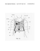 ADJUSTABLE THORACIC GARMENTS USEABLE BY PATIENTS HAVING DIFFERENT THORACIC     DIMENSIONS FOR LOCATING EM TRANSDUCER(S) IN PROXIMITY TO PREDEFINED     THORACIC ANATOMIC FEATURES diagram and image