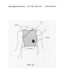 ADJUSTABLE THORACIC GARMENTS USEABLE BY PATIENTS HAVING DIFFERENT THORACIC     DIMENSIONS FOR LOCATING EM TRANSDUCER(S) IN PROXIMITY TO PREDEFINED     THORACIC ANATOMIC FEATURES diagram and image