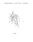 SYSTEMS AND METHODS FOR TREATMENT OF AN AIRWAY DISORDER diagram and image