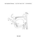 SYSTEMS AND METHODS FOR TREATMENT OF AN AIRWAY DISORDER diagram and image