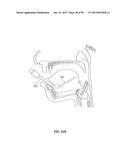 SYSTEMS AND METHODS FOR TREATMENT OF AN AIRWAY DISORDER diagram and image