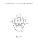 SYSTEMS AND METHODS FOR TREATMENT OF AN AIRWAY DISORDER diagram and image