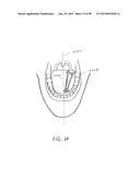 SYSTEMS AND METHODS FOR TREATMENT OF AN AIRWAY DISORDER diagram and image