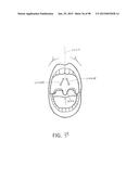 SYSTEMS AND METHODS FOR TREATMENT OF AN AIRWAY DISORDER diagram and image