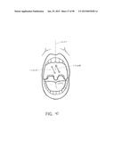 SYSTEMS AND METHODS FOR TREATMENT OF AN AIRWAY DISORDER diagram and image