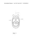 SYSTEMS AND METHODS FOR TREATMENT OF AN AIRWAY DISORDER diagram and image