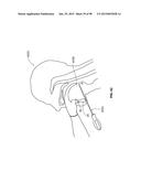 SYSTEMS AND METHODS FOR TREATMENT OF AN AIRWAY DISORDER diagram and image