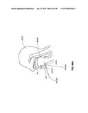 SYSTEMS AND METHODS FOR TREATMENT OF AN AIRWAY DISORDER diagram and image