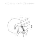 SYSTEMS AND METHODS FOR TREATMENT OF AN AIRWAY DISORDER diagram and image