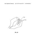 SYSTEMS AND METHODS FOR TREATMENT OF AN AIRWAY DISORDER diagram and image