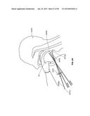 SYSTEMS AND METHODS FOR TREATMENT OF AN AIRWAY DISORDER diagram and image