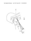 SYSTEMS AND METHODS FOR TREATMENT OF AN AIRWAY DISORDER diagram and image