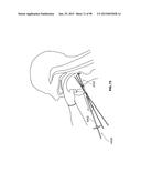 SYSTEMS AND METHODS FOR TREATMENT OF AN AIRWAY DISORDER diagram and image