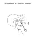 SYSTEMS AND METHODS FOR TREATMENT OF AN AIRWAY DISORDER diagram and image