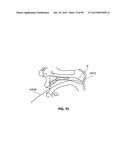 SYSTEMS AND METHODS FOR TREATMENT OF AN AIRWAY DISORDER diagram and image