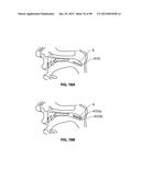 SYSTEMS AND METHODS FOR TREATMENT OF AN AIRWAY DISORDER diagram and image