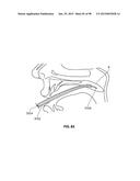 SYSTEMS AND METHODS FOR TREATMENT OF AN AIRWAY DISORDER diagram and image